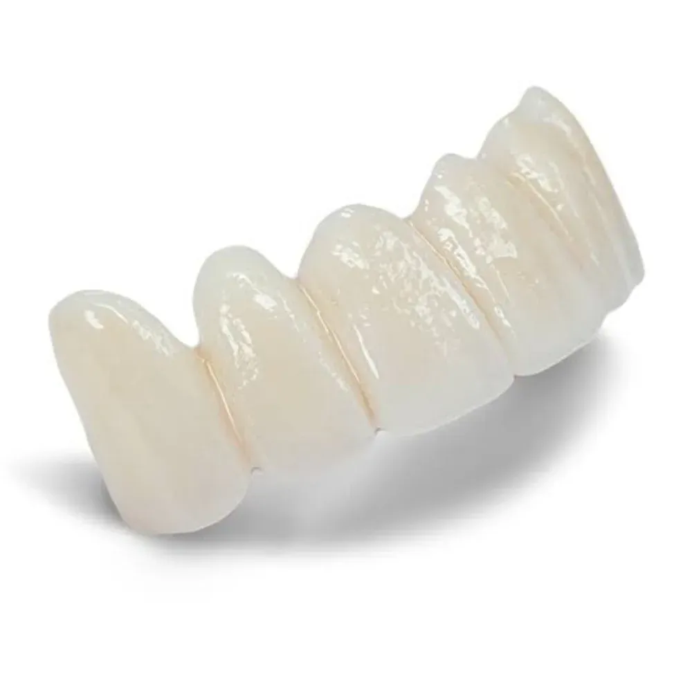 Monolithic zirconia bridge on the master model