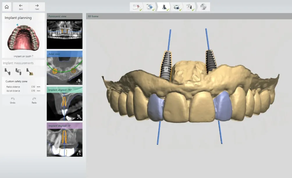 Guided implant planning software: panoramic and axial CBCT views beside the 3D scene, with the planned implant positions and custom safety zones on the maxillary arch.