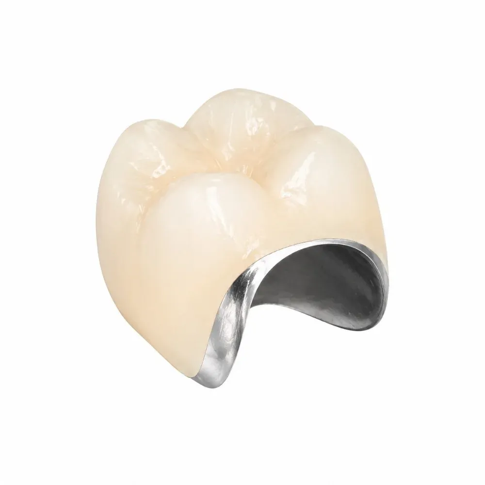 PFM crown, cast metal coping under stratified porcelain