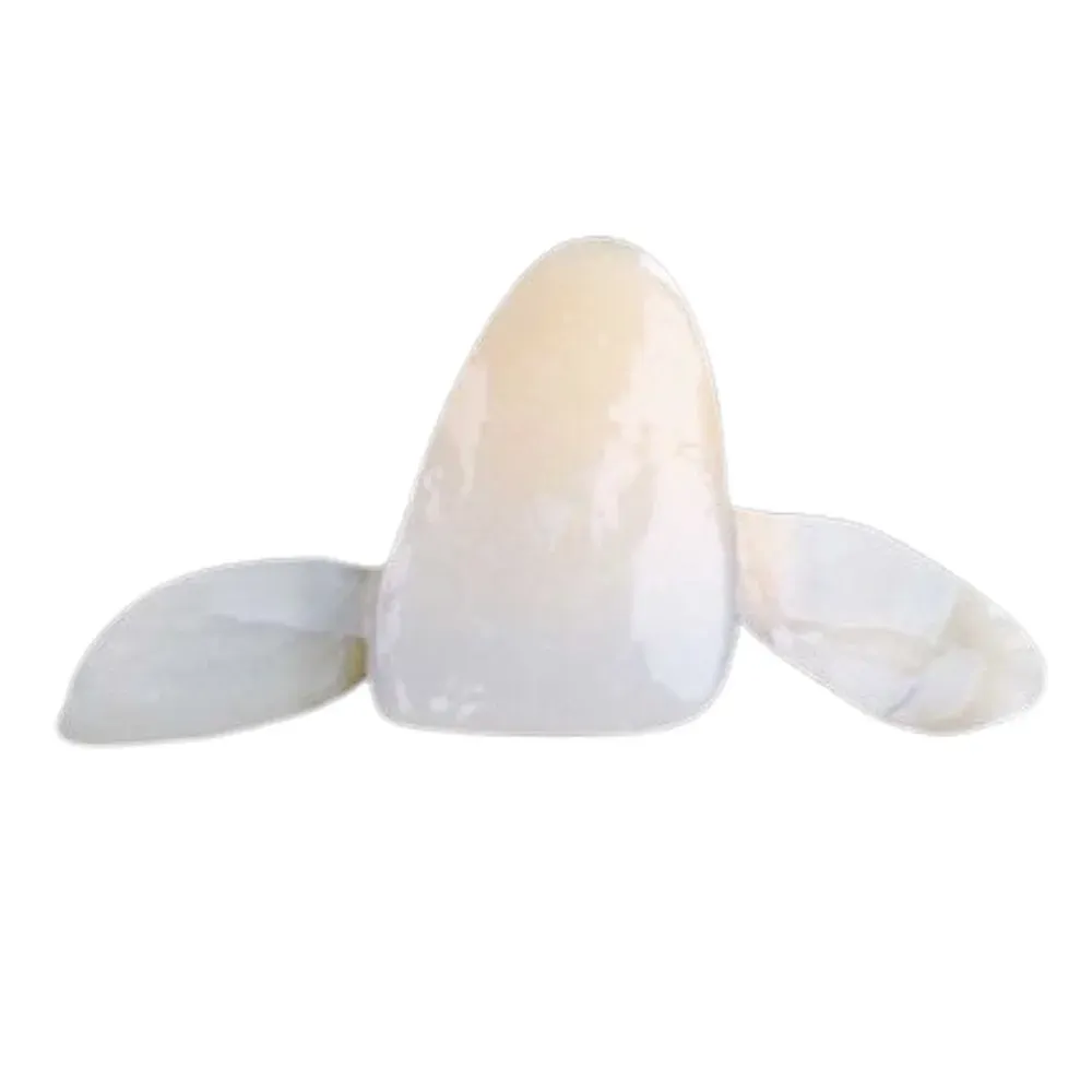 Resin-bonded bridge, retainer wing bonded to the lingual enamel
