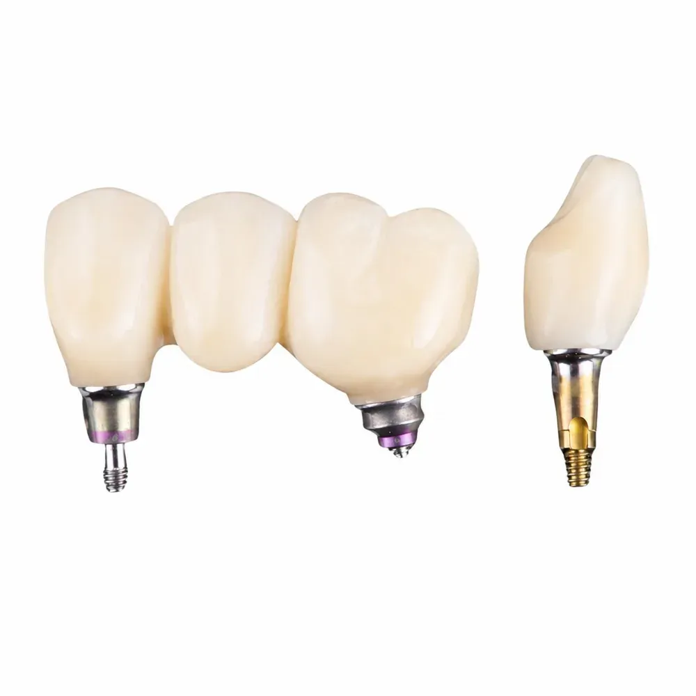 Bridge seated on implant abutments, master model