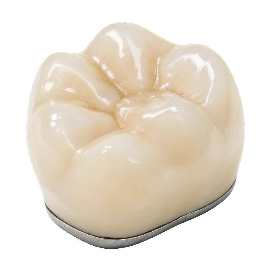 A porcelain-fused-to-metal crown with the metal collar visible at the margin.