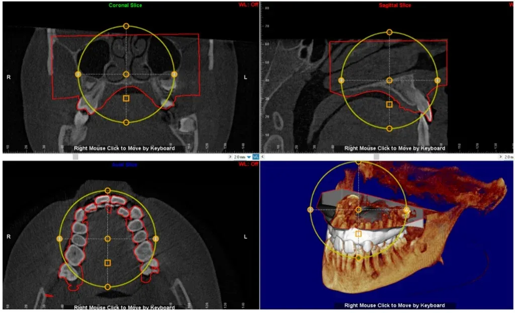 3D implant planning scene against CBCT and restorative endpoint