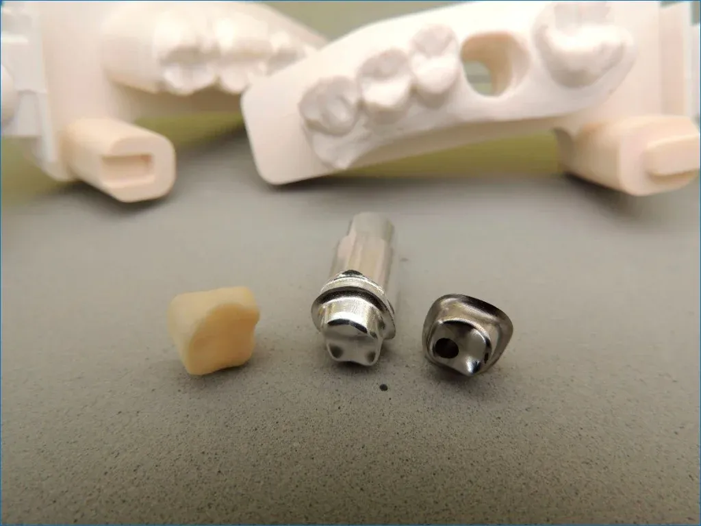 Custom titanium abutment shaping the emergence toward the final crown