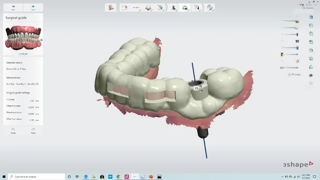 Guided planning software showing implant positions and the drill sequence overlaid on a CBCT