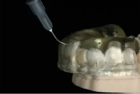 Cross-polarized shade photograph of anterior teeth with a shade tab