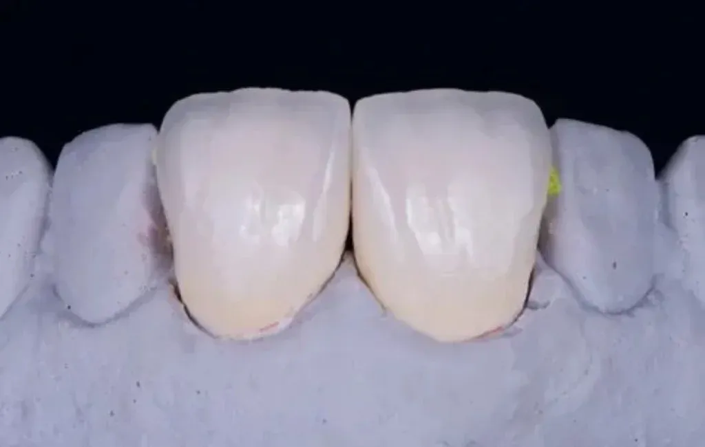 Minimal-prep IPS e.max veneers for an anterior esthetic case.