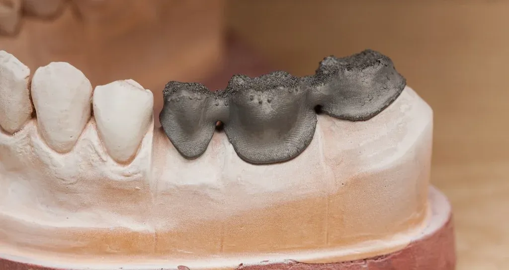 PFM bridge framework cast by lost-wax before porcelain