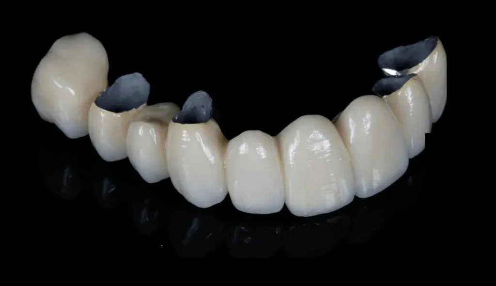 PFM crowns finished to a consistent lab standard for multi-location cases.