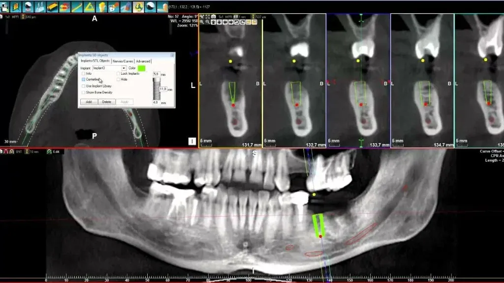 Technician reviewing an edentulous arch on CBCT beside the planned hybrid on screen