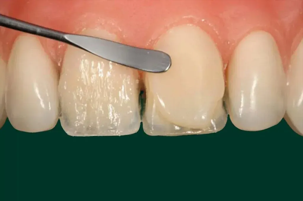 A technician checking incisal plane and midline across the arch on the model