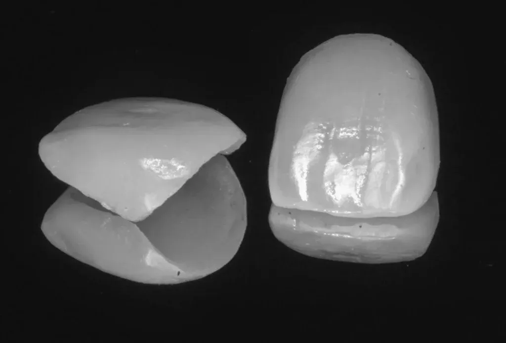Layered anterior restoration showing value, translucency, and surface texture