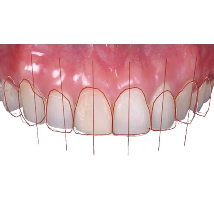 Retracted and smile photos with midline and incisal-plane guidelines overlaid