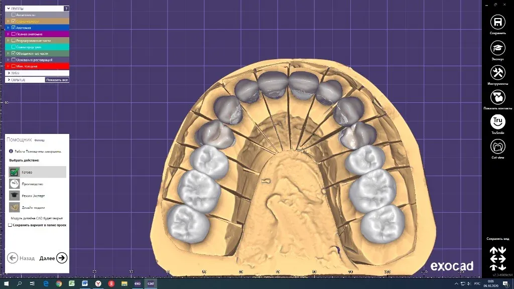 Design-proof render of a restoration sent to a dentist for approval on screen