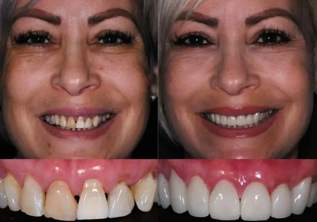 Patient evaluating the seated trial smile in a hand mirror at the chair