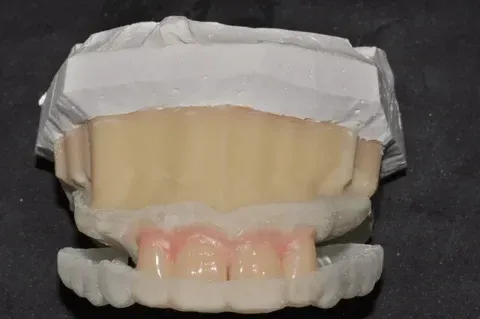 Printed matrix loaded with provisional material seated for an intraoral mockup