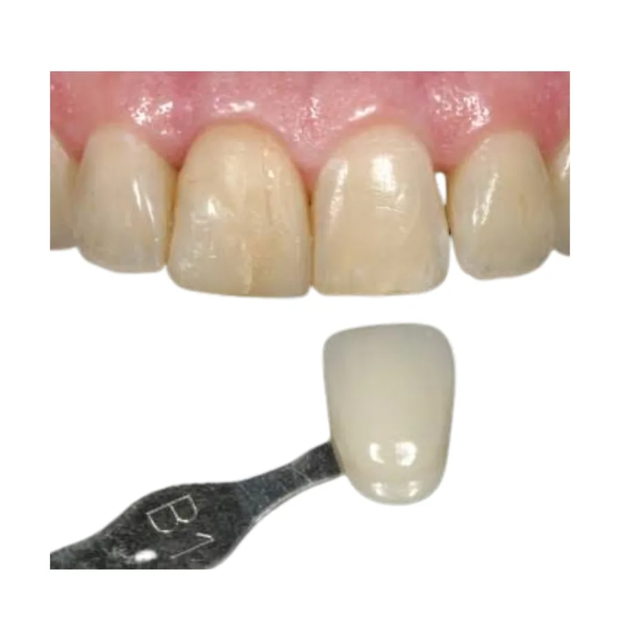 Shade tab held against a crown for custom shade matching