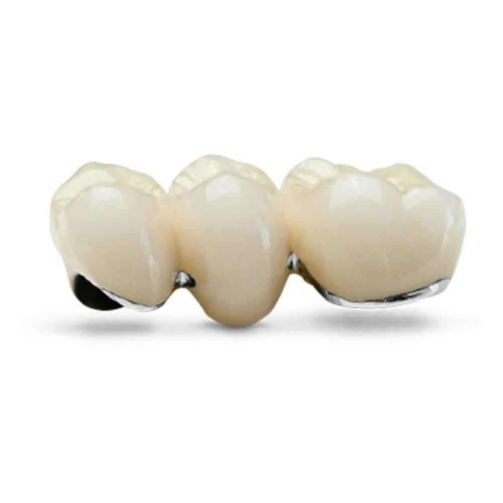 Porcelain-fused-to-metal dental bridge