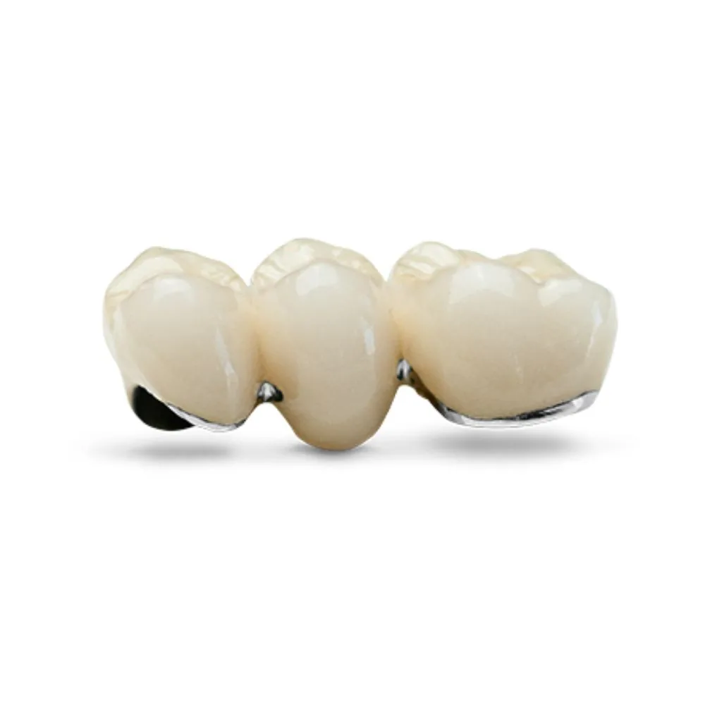 Porcelain-fused-to-metal crown