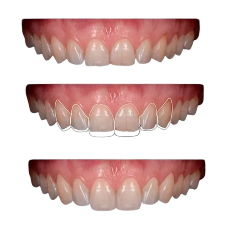 Printed smile mockup ready for intraoral try-in