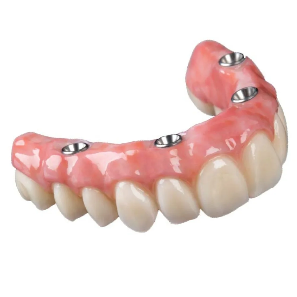 Implant-supported denture