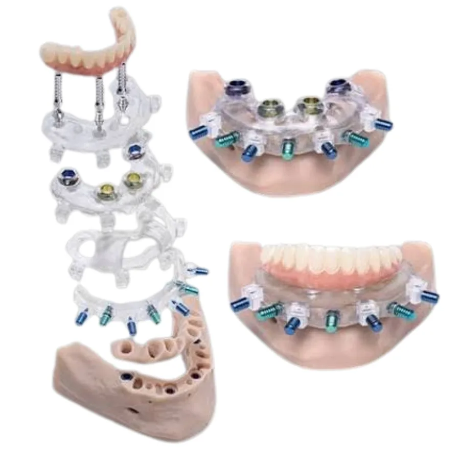CBCT and intraoral scans merged for guided implant planning on screen